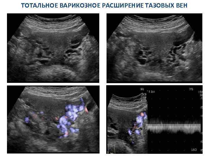 ТОТАЛЬНОЕ ВАРИКОЗНОЕ РАСШИРЕНИЕ ТАЗОВЫХ ВЕН 180 