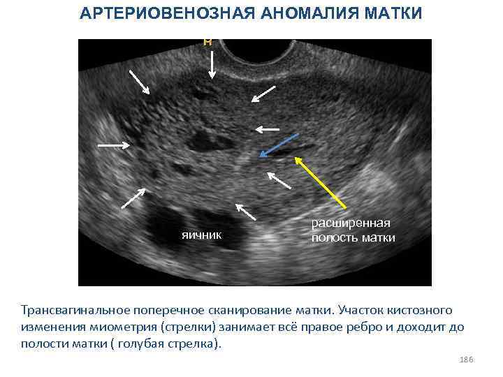 АРТЕРИОВЕНОЗНАЯ АНОМАЛИЯ МАТКИ яичник расширенная полость матки Трансвагинальное поперечное сканирование матки. Участок кистозного изменения