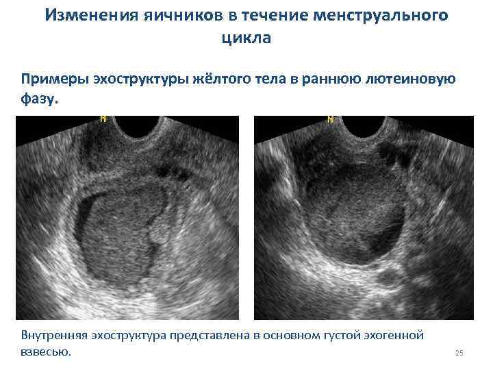 Изменения яичников в течение менструального цикла Примеры эхоструктуры жёлтого тела в раннюю лютеиновую фазу.