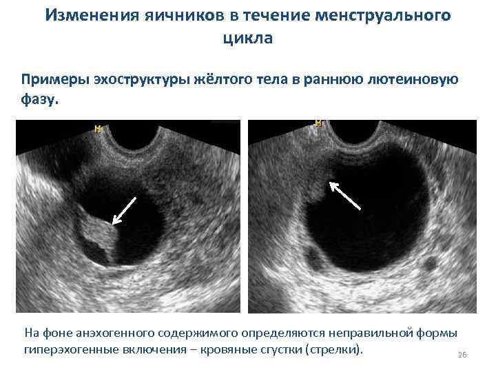 Изменения яичников в течение менструального цикла Примеры эхоструктуры жёлтого тела в раннюю лютеиновую фазу.