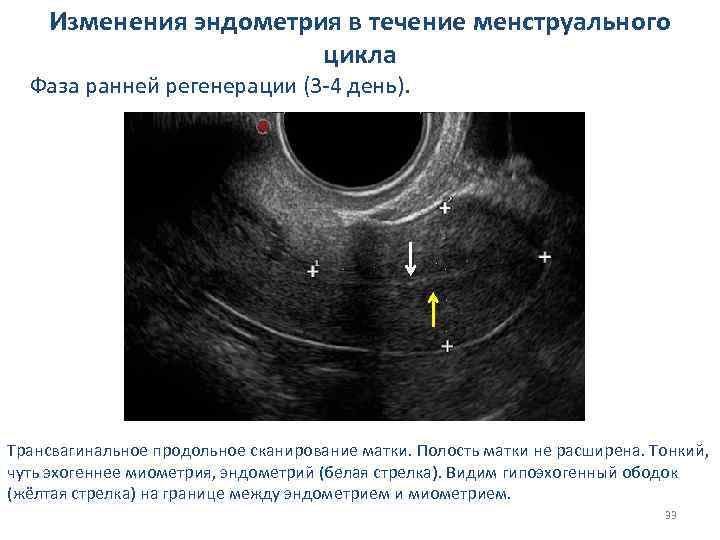 Изменения эндометрия в течение менструального цикла Фаза ранней регенерации (3 -4 день). Трансвагинальное продольное
