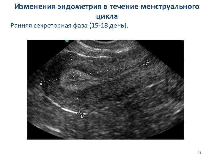 Изменения эндометрия в течение менструального цикла Ранняя секреторная фаза (15 -18 день). 41 