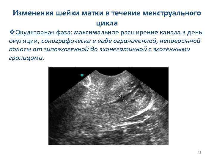 Изменения шейки матки в течение менструального цикла v. Овуляторная фаза: максимальное расширение канала в