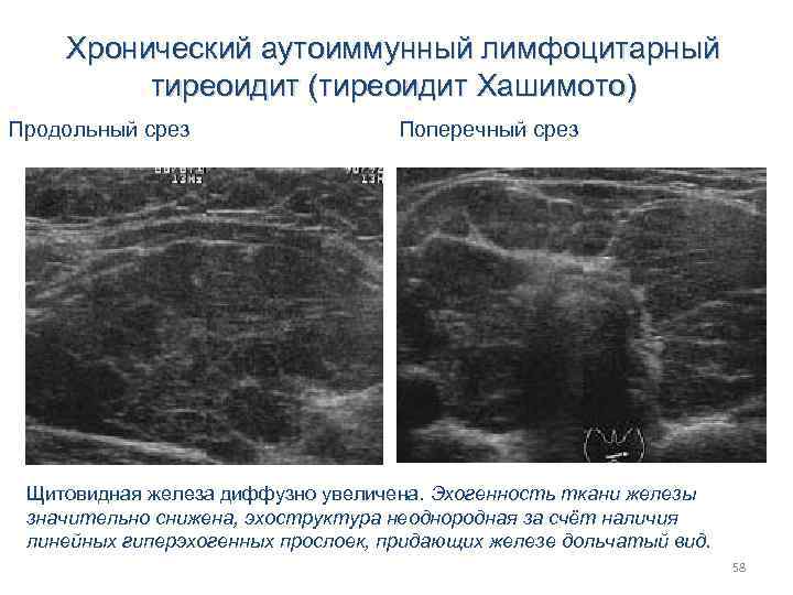 Хронический аутоиммунный лимфоцитарный тиреоидит (тиреоидит Хашимото) Продольный срез Поперечный срез Щитовидная железа диффузно увеличена.