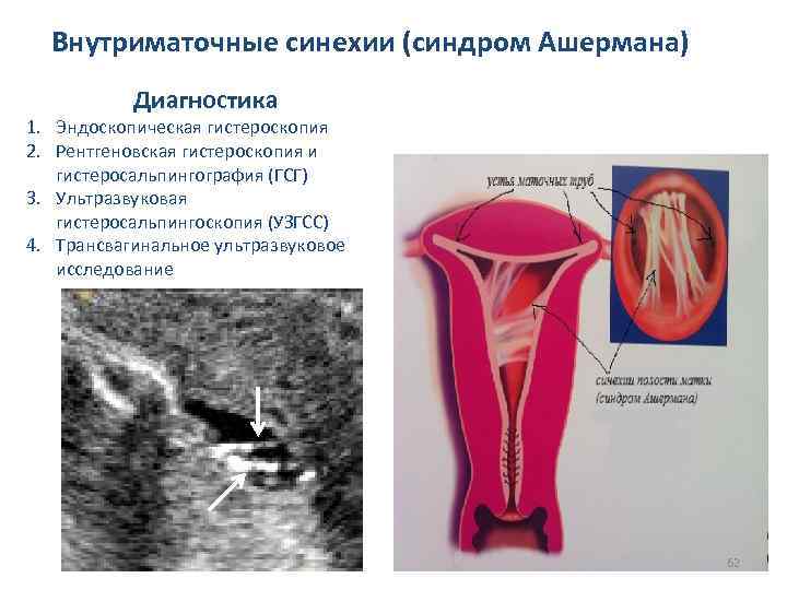 Внутриматочные синехии (синдром Ашермана) Диагностика 1. Эндоскопическая гистероскопия 2. Рентгеновская гистероскопия и гистеросальпингография (ГСГ)
