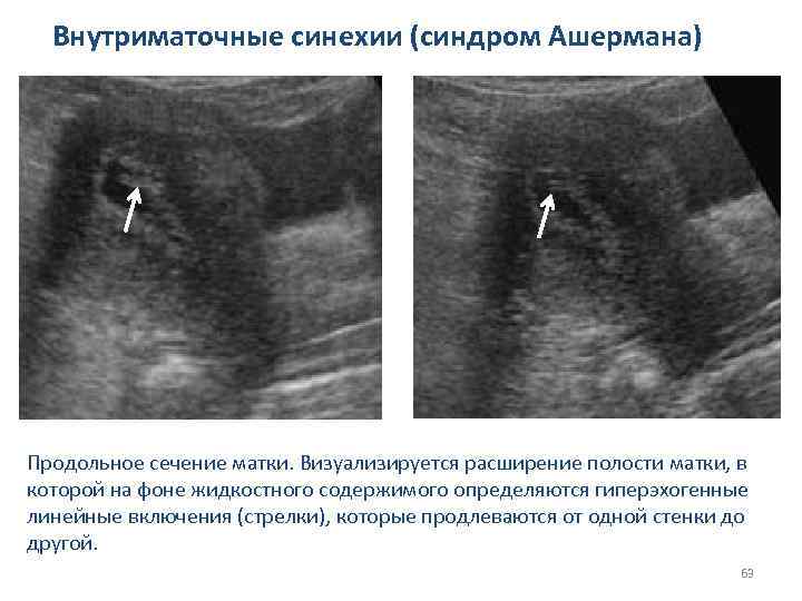 Внутриматочные синехии (синдром Ашермана) Продольное сечение матки. Визуализируется расширение полости матки, в которой на