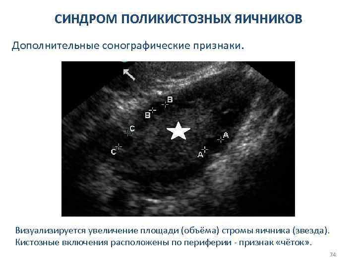СИНДРОМ ПОЛИКИСТОЗНЫХ ЯИЧНИКОВ Дополнительные сонографические признаки. Визуализируется увеличение площади (объёма) стромы яичника (звезда). Кистозные