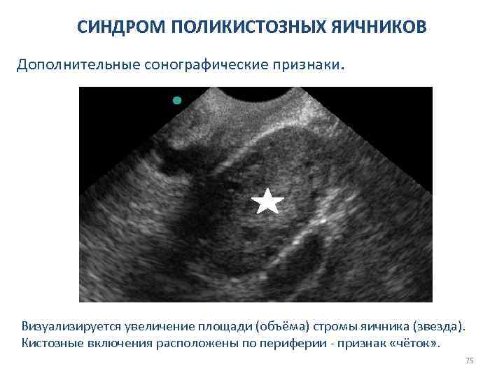 СИНДРОМ ПОЛИКИСТОЗНЫХ ЯИЧНИКОВ Дополнительные сонографические признаки. Визуализируется увеличение площади (объёма) стромы яичника (звезда). Кистозные