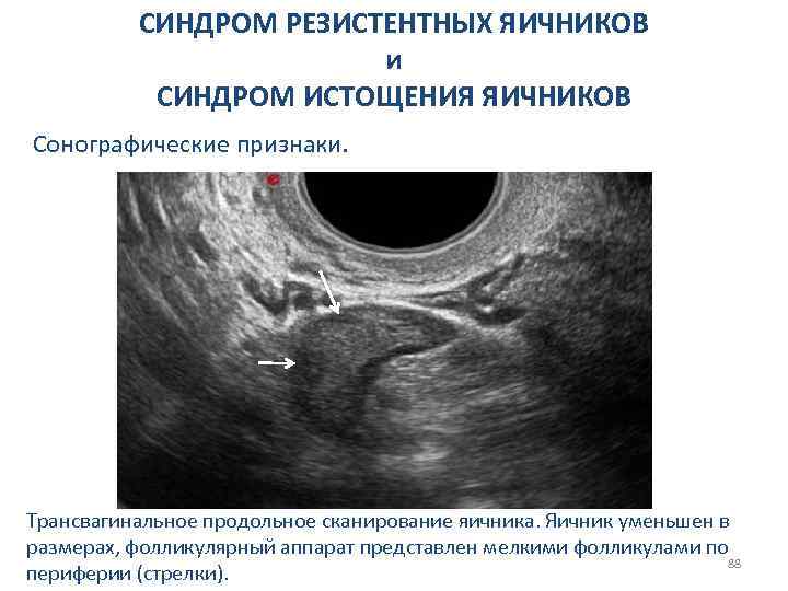 СИНДРОМ РЕЗИСТЕНТНЫХ ЯИЧНИКОВ и СИНДРОМ ИСТОЩЕНИЯ ЯИЧНИКОВ Сонографические признаки. Трансвагинальное продольное сканирование яичника. Яичник