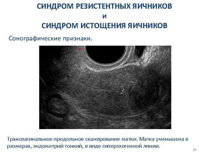 СИНДРОМ РЕЗИСТЕНТНЫХ ЯИЧНИКОВ и СИНДРОМ ИСТОЩЕНИЯ ЯИЧНИКОВ Сонографические признаки. Трансвагинальное продольное сканирование матки. Матка