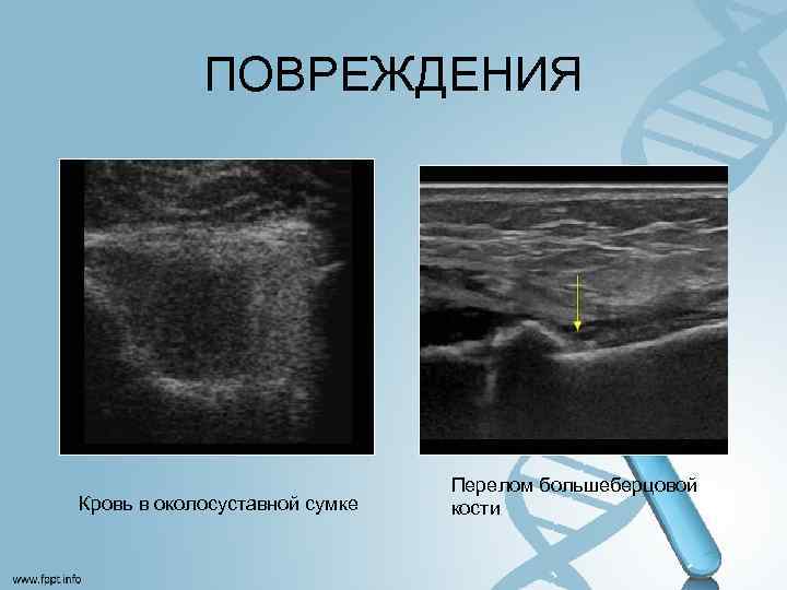 ПОВРЕЖДЕНИЯ Кровь в околосуставной сумке Перелом большеберцовой кости 