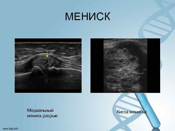 МЕНИСК Медиальный мениск разрыв Киста мениска 