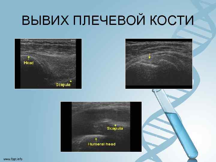 ВЫВИХ ПЛЕЧЕВОЙ КОСТИ 