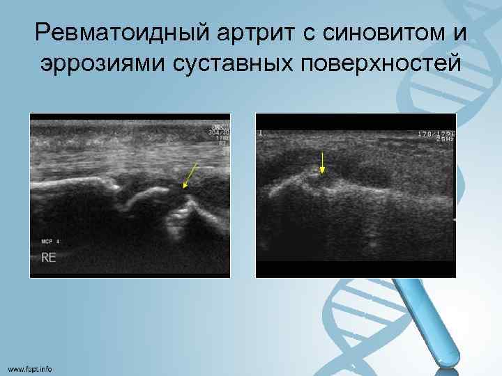 Ревматоидный артрит с синовитом и эррозиями суставных поверхностей 