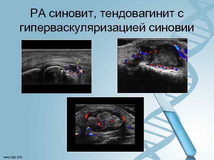 РА синовит, тендовагинит с гиперваскуляризацией синовии 