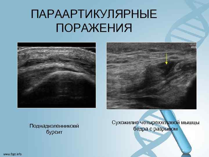 ПАРААРТИКУЛЯРНЫЕ ПОРАЖЕНИЯ Поднадколенниковй бурсит Сухожилие четыреххглавой мышцы бедра с разрывом 