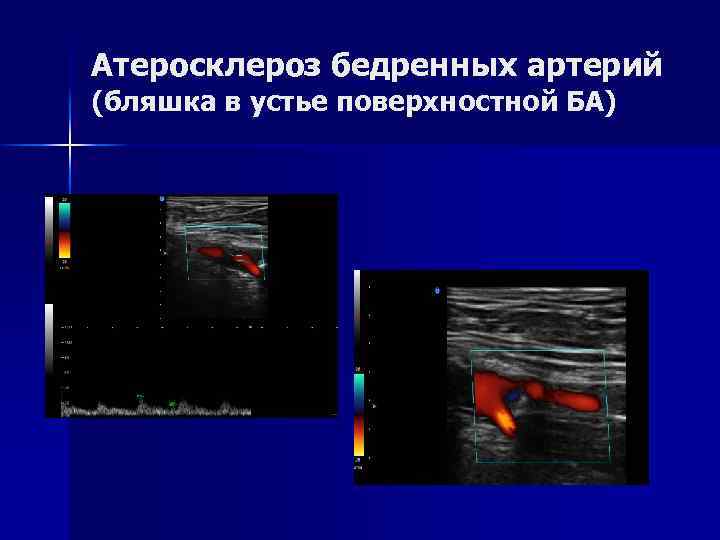 Давление бедренной артерии. Атеросклероз бедренной артерии. УЗИ бедренных артерий.
