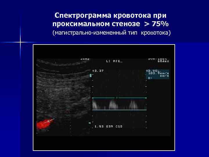 Определение скорости кровотока в сосудах. Магистрально измененный Тип кровотока на УЗИ. Магистральный и коллатеральный Тип кровотока на УЗИ. Тип кровотока магистральный измененный коллатеральный на УЗИ. Магистральный измененный Тип допплерография.