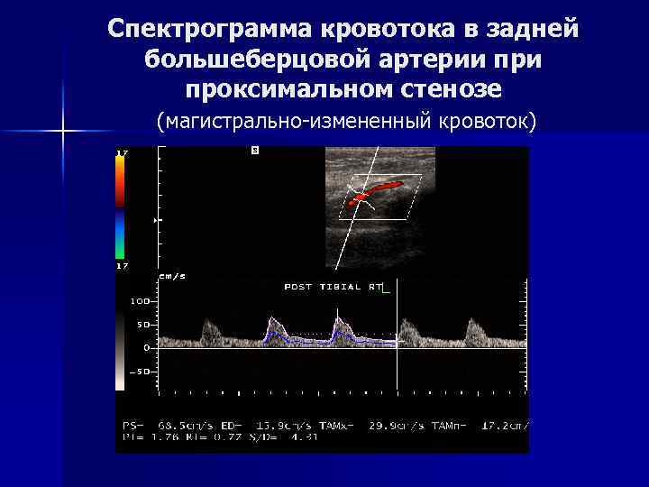 Спектрограмма кровотока в задней большеберцовой артерии проксимальном стенозе (магистрально-измененный кровоток) 