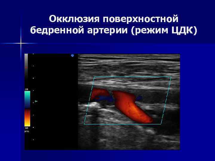 Окклюзия поверхностной бедренной артерии (режим ЦДК) 