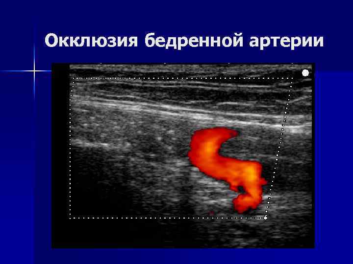 Окклюзия бедренной артерии 