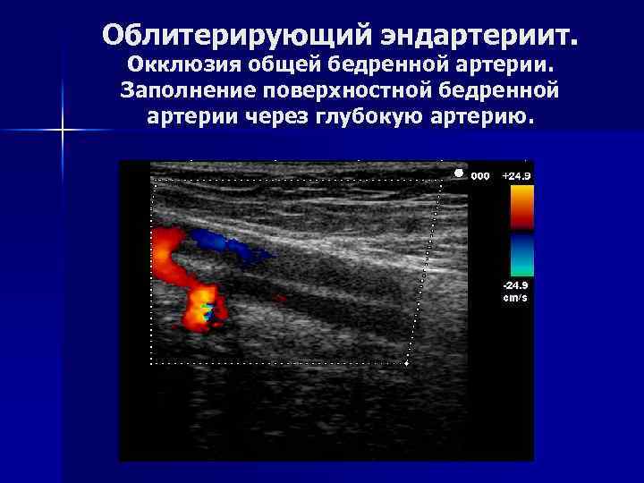 Облитерирующий эндартериит. Окклюзия общей бедренной артерии. Заполнение поверхностной бедренной артерии через глубокую артерию. 