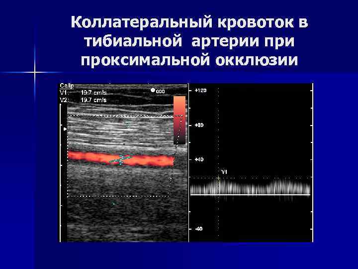 Коллатеральный кровоток в тибиальной артерии проксимальной окклюзии 