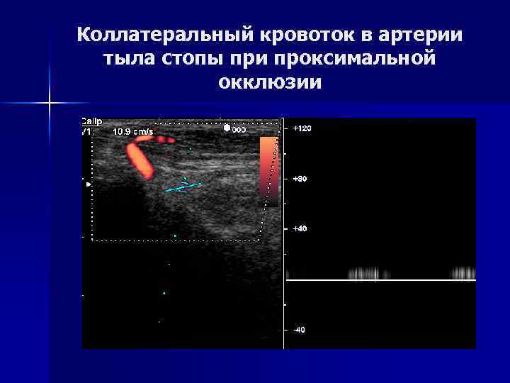 Коллатеральный кровоток в артерии тыла стопы при проксимальной окклюзии 