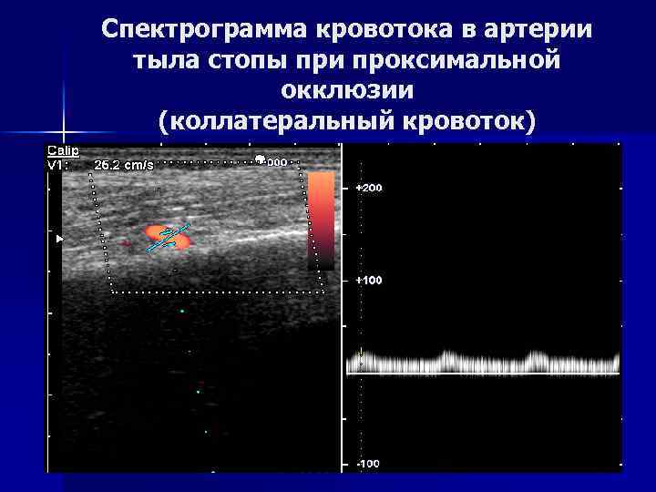 Спектрограмма кровотока в артерии тыла стопы при проксимальной окклюзии (коллатеральный кровоток) 