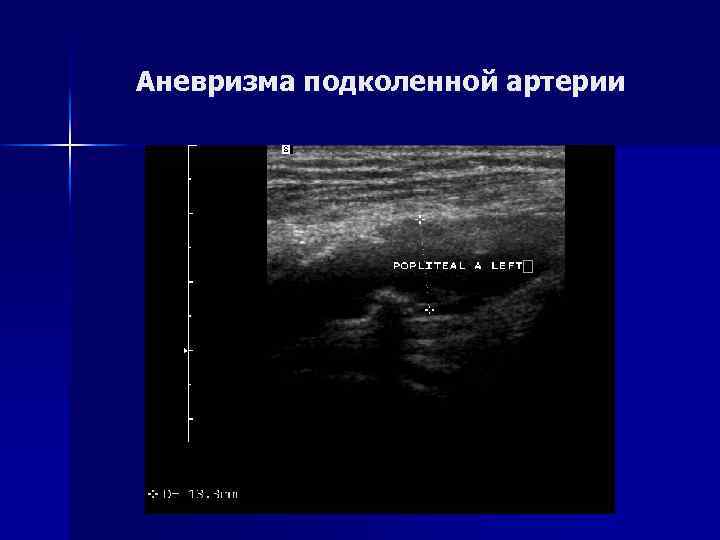 Аневризма подколенной артерии 