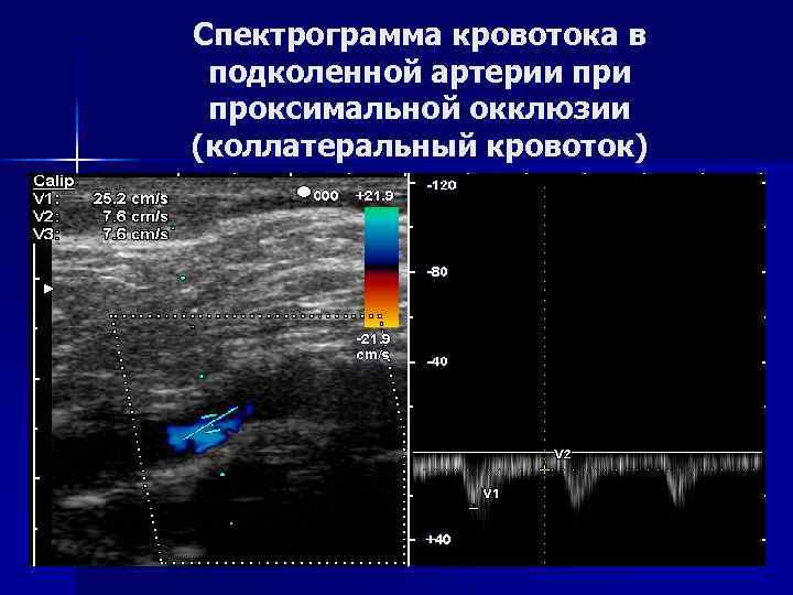 Окклюзия подколенной артерии. Магистральный и коллатеральный Тип кровотока на УЗИ. Коллатеральный Тип кровотока спектр. Магистральных Тип кровотока в артерия ног. Магистрально измененный кровоток в артериях нижних конечностей.