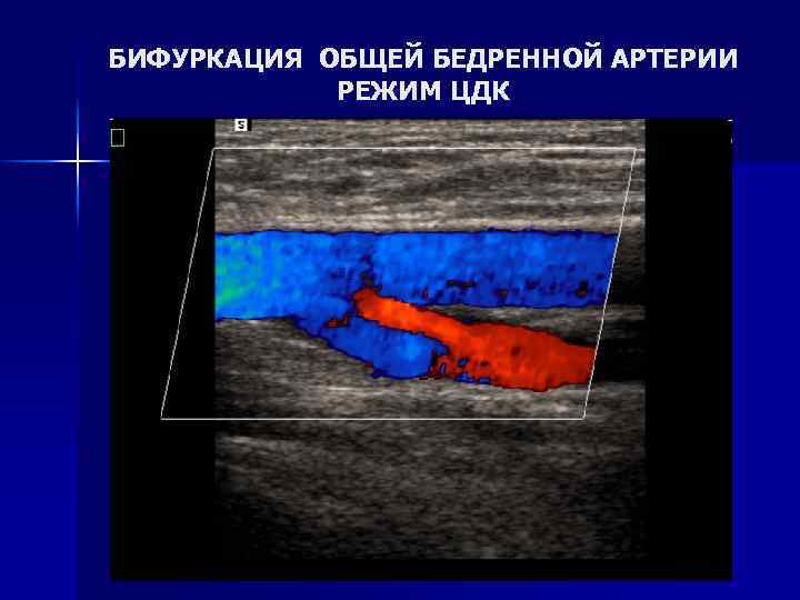 БИФУРКАЦИЯ ОБЩЕЙ БЕДРЕННОЙ АРТЕРИИ РЕЖИМ ЦДК 