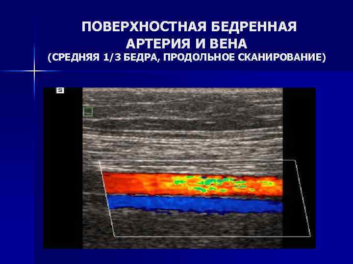 ПОВЕРХНОСТНАЯ БЕДРЕННАЯ АРТЕРИЯ И ВЕНА (СРЕДНЯЯ 1/3 БЕДРА, ПРОДОЛЬНОЕ СКАНИРОВАНИЕ) 