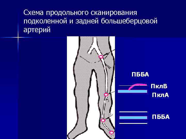 Схема продольного сканирования подколенной и задней большеберцовой артерий ПББА Пкл. В Пкл. А ПББА