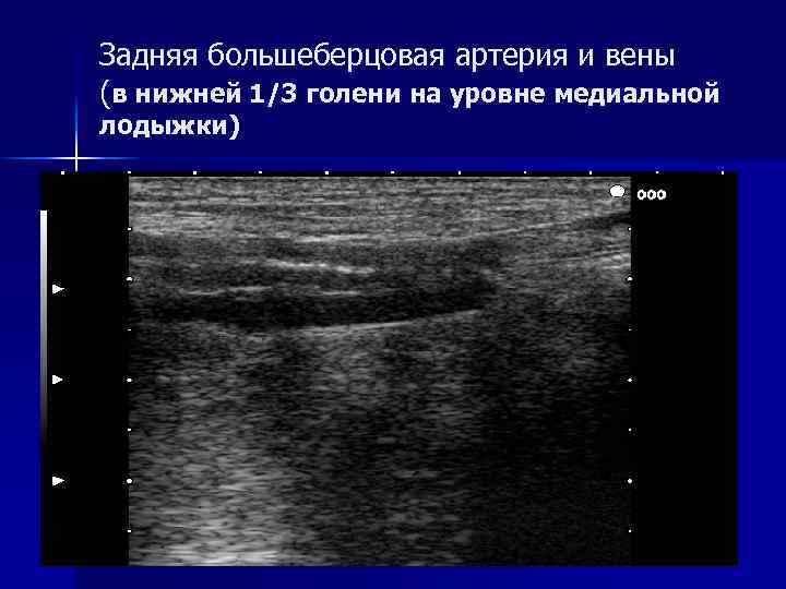 Задняя большеберцовая артерия и вены (в нижней 1/3 голени на уровне медиальной лодыжки) 