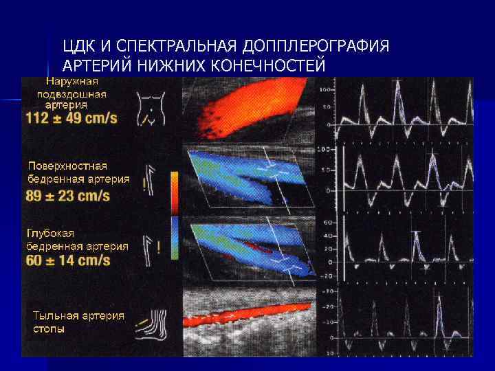 Схема тромбоза при атеросклерозе мозговых артерий