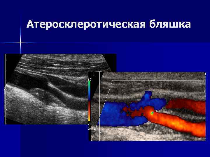 Склеротические бляшки. Атеросклеротическая бляшка. Гипоэхогенная бляшка. Бляшка атеросклеротическая удаленная. Атеросклеротическая бляшка УЗИ.