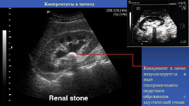 Конкременты в почках Конкремент в почке визуализируется в виде гиперэхогенного округлого образования с акустической