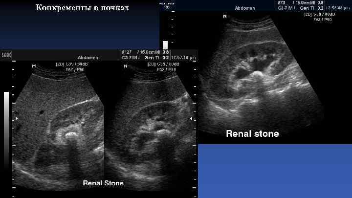 Конкременты в почках 