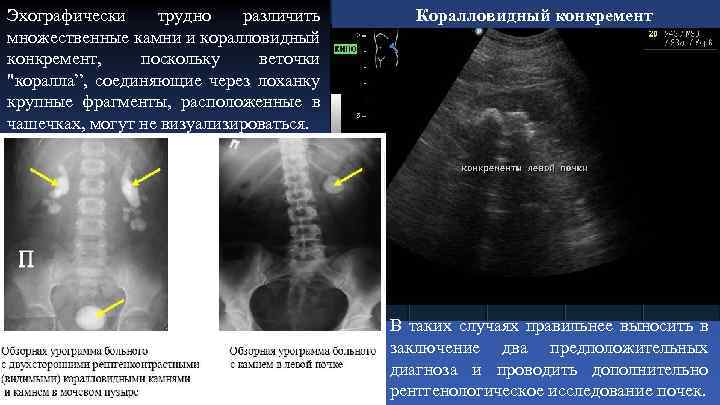 Эхографически трудно различить множественные камни и коралловидный конкремент, поскольку веточки 