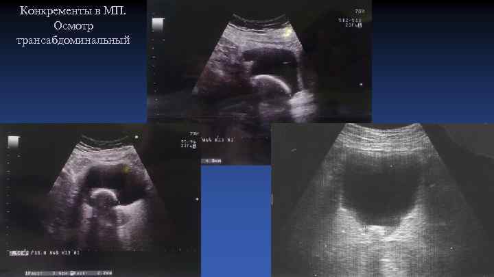 Конкременты в МП. Осмотр трансабдоминальный 