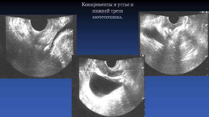 Конкременты в устье и нижней трети мочеточника. 