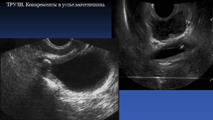 ТРУЗИ. Конкременты в устье мочеточника 