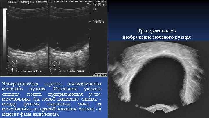 Трансректальное изображение мочевого пузыря Эхографическая картина неизмененного мочевого пузыря. Стрелками указана складка стенки, прикрывающая