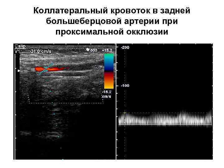 Коллатеральный кровоток в задней большеберцовой артерии проксимальной окклюзии 