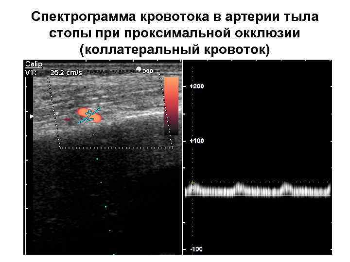 Спектрограмма кровотока в артерии тыла стопы при проксимальной окклюзии (коллатеральный кровоток) 