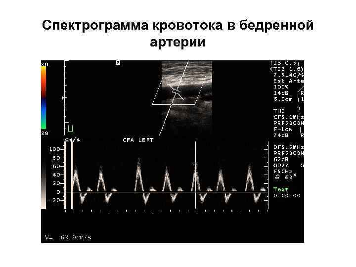 Спектрограмма кровотока в бедренной артерии 