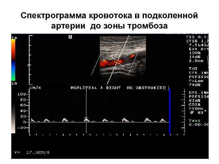 Спектрограмма кровотока в подколенной артерии до зоны тромбоза 