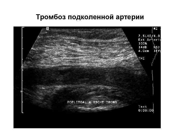 Тромбоз подколенной артерии 