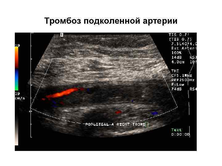Тромбоз подколенной артерии 